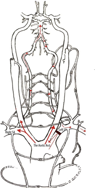 File:Subclavian Steal Diagram.png