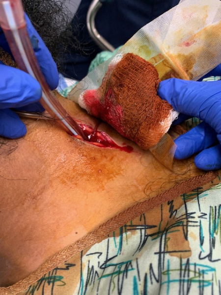 File:Surgical cricothyrotomy.JPG