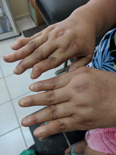 File:Swan neck deformity.jpg