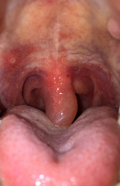 File:Swollen Uvula.jpg