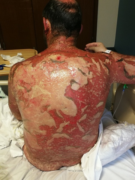 File:TENS patient on day 10.jpg