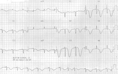 T Waves inversion in subarachnoid hemorrhage