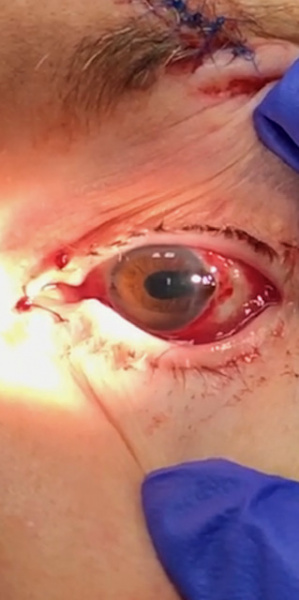 File:Teardrop pupil.jpg