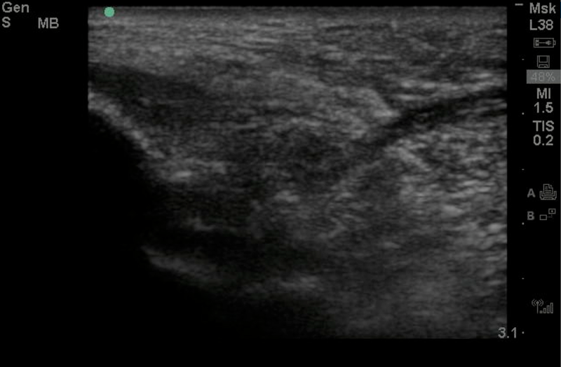File:Tendon Rupture.png