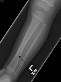 Distal leg fractures - WikEM