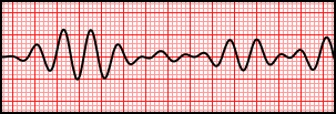 Rorsades de Pointes in a rhythm strip.