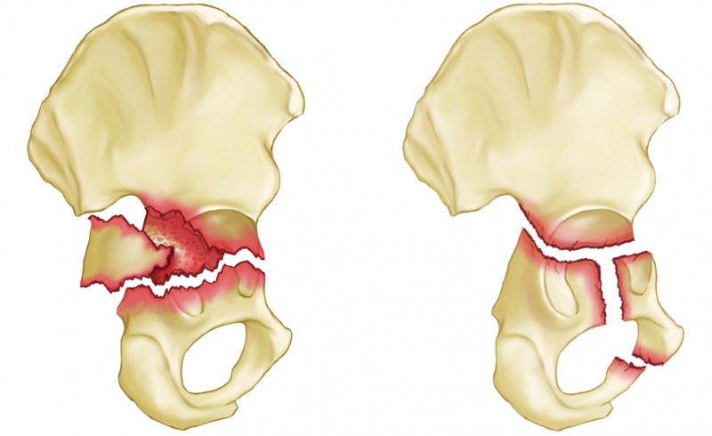 File:Transverse T shaped fractures.jpg