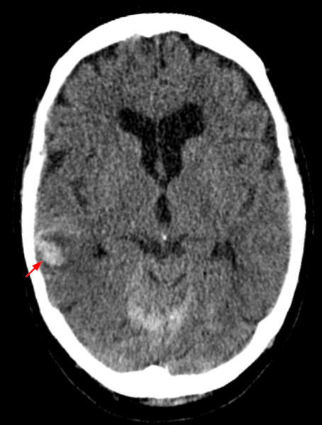File:Traumatische SAB 001 Kontrolle mit Aufbluehen.png