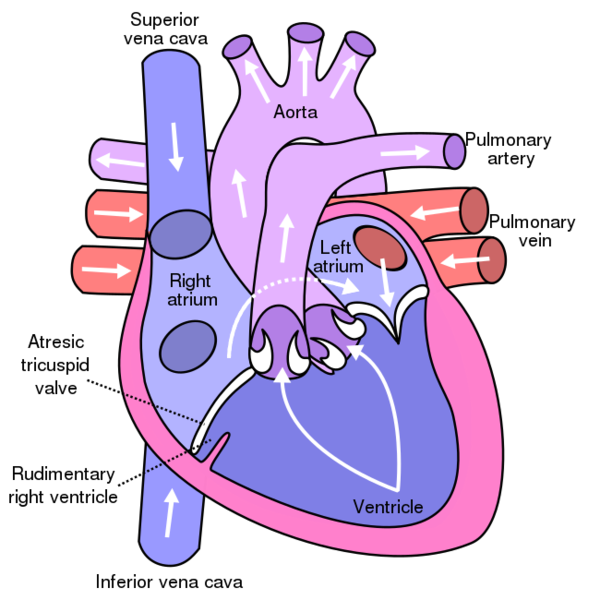 File:Tricuspid atresia.svg