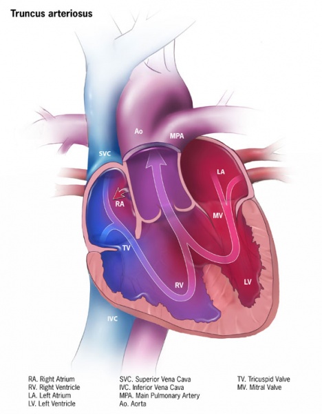 File:Truncus arteriosus.jpg