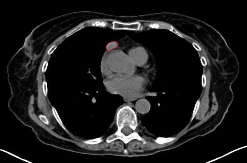 File:Tumor Thymoma1.jpg