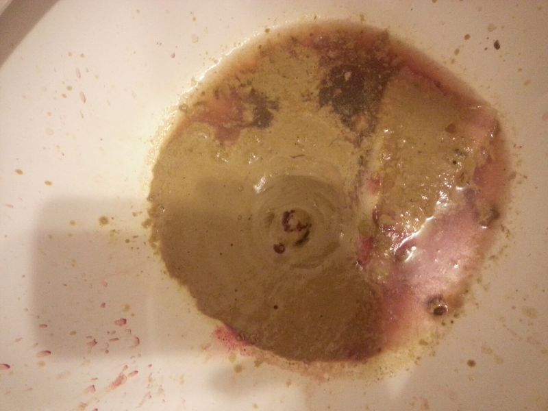 File:Typhoid Stool.jpg