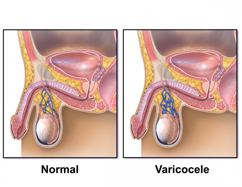 File:Varicocele.png