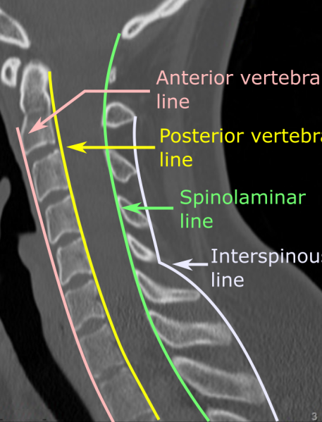 File:Vertebral lines.png