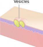 Vesicles.png