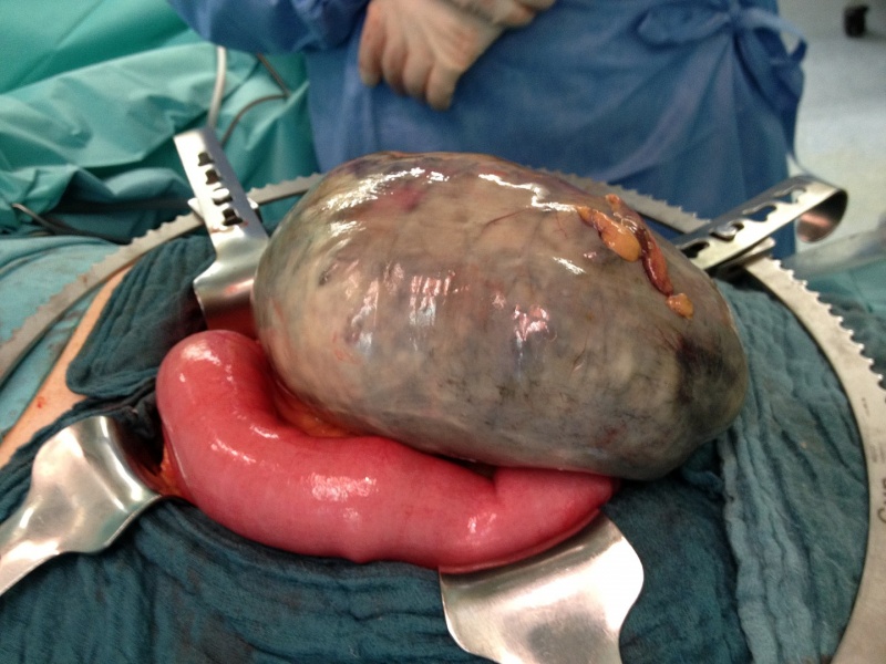 File:Volvulus (Dickdarm).jpg