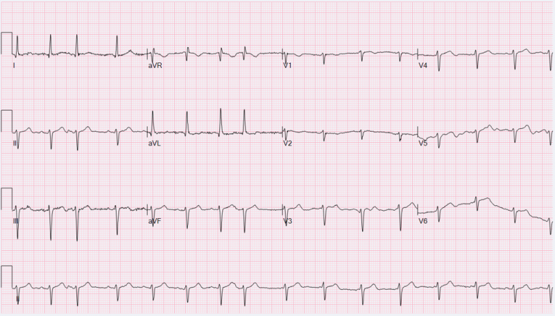 File:Wandering atrial pacemaker.png