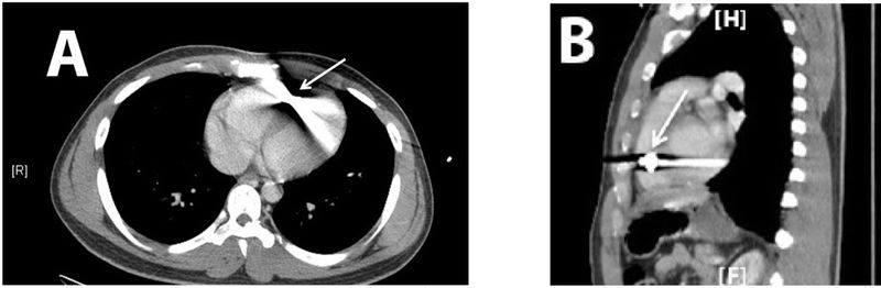 File:Wjem-16-489 copy cxr.jpg