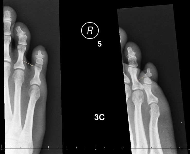 File:X-rays of foot phalanx.jpg