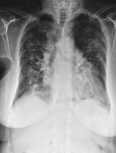 File:Xray Amiodarone Lung toxicity.png